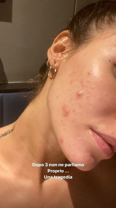 Giulia De Lellis Mostra L Acne Non Dobbiamo Vergognarci Tgcom24