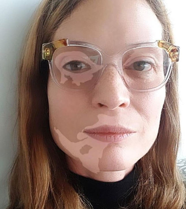 Kasia Smutniak fiera della sua vitiligine: “Ho creato un filtro, più