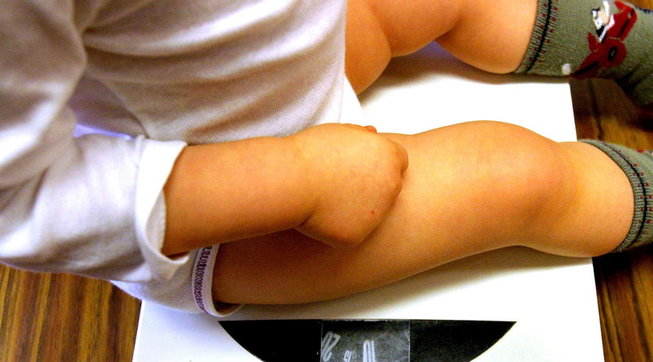obesità, bambini, obesità minorile, sovrappeso, bambini grassi
