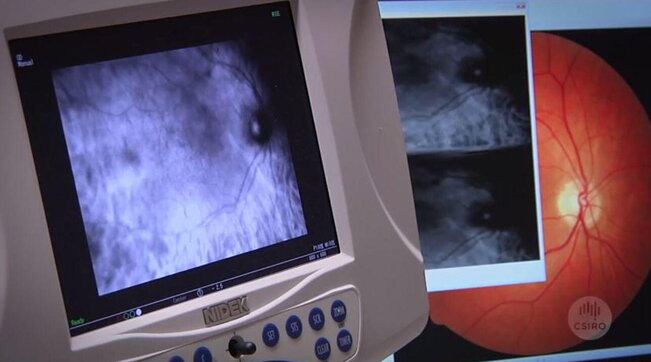 retina alzheimer csiro test occhio