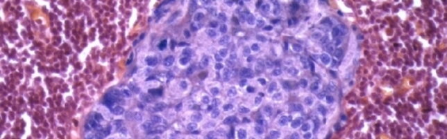 Tumori, scoperto il ruolo di una proteina nella sopravvivenza delle cellule malate