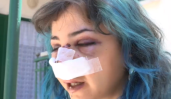 Anteprima: Bari, ragazza aggredita da sconosciuti: "Tormentavano tutti i passanti, io ho reagito"